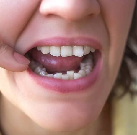 Lady has crowded teeth