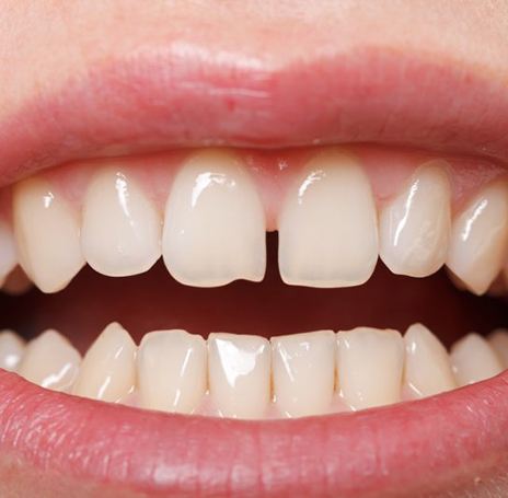 Teeth with gap