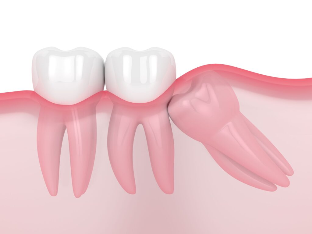 Illustration showing wisdom tooth pushing against neighboring molar under the gums